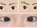 矫正视力低是什么原因，矫正视力低是什么原因造成的